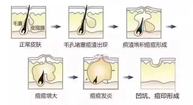 如何祛除痘坑？祛除痘坑最好的方法