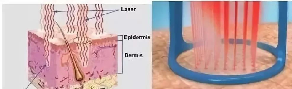 如何祛除痘坑？祛除痘坑最好的方法