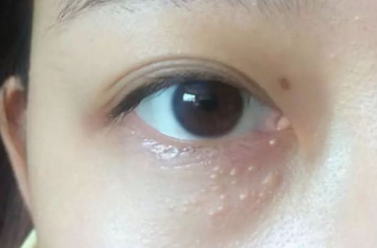 為什么眼部容易長(zhǎng)脂肪粒？