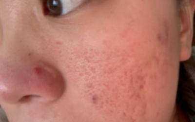 去痘印做什么醫(yī)美項(xiàng)目最好？